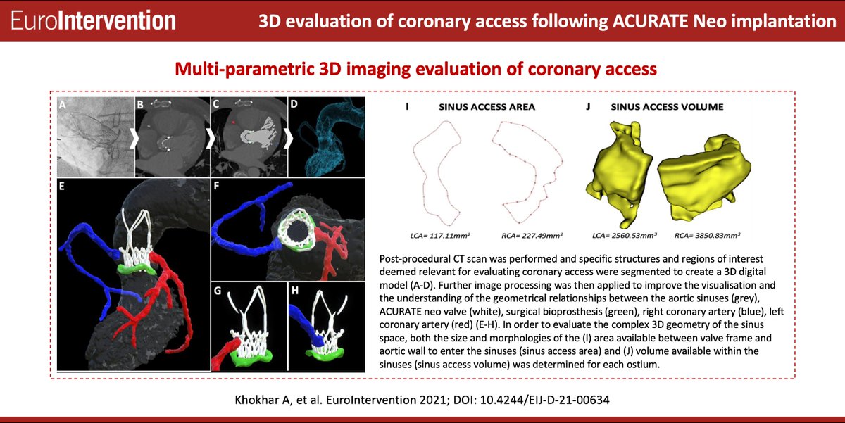 EuroIntervention (@eurointerventio) on Twitter photo Just Accepted Article: A computed tomography-based, three-dimensional multi-parametric imaging approach to evaluate coronary access following ACURATE Neo implantation in a degenerated surgical bioprosthesis. ow.ly/6fSs50FWTn3 Just Accepted Article: A computed tomography-based, three-dimensional multi-parametric imaging approach to evaluate coronary access following ACURATE Neo implantation in a degenerated surgical bioprosthesis. ow.ly/6fSs50FWTn3