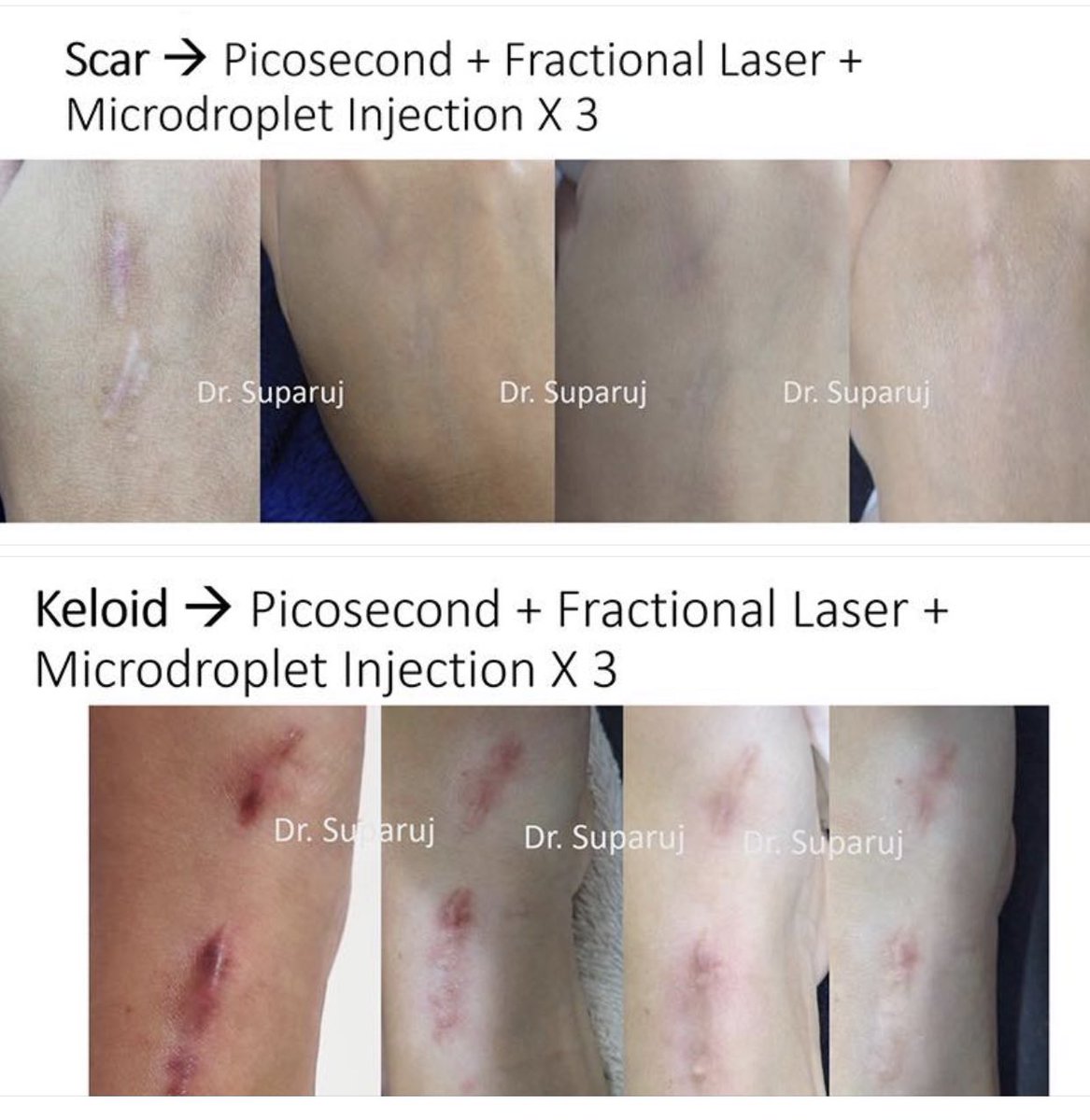 DrSuparuj's tweet photo. 📍Review ผลการรักษาแผลเป็นนูน Scar Treatment
#หมอรุจชวนคุย 👨⚕️😉🔬
#รักษาแผลเป็น #แผลเป็น #คีลอยด์ #PicosecondLaser #FractionalLaser #InfiniRF
https://t.co/IZMDl5K3JF https://t.co/f9YtzCdt04