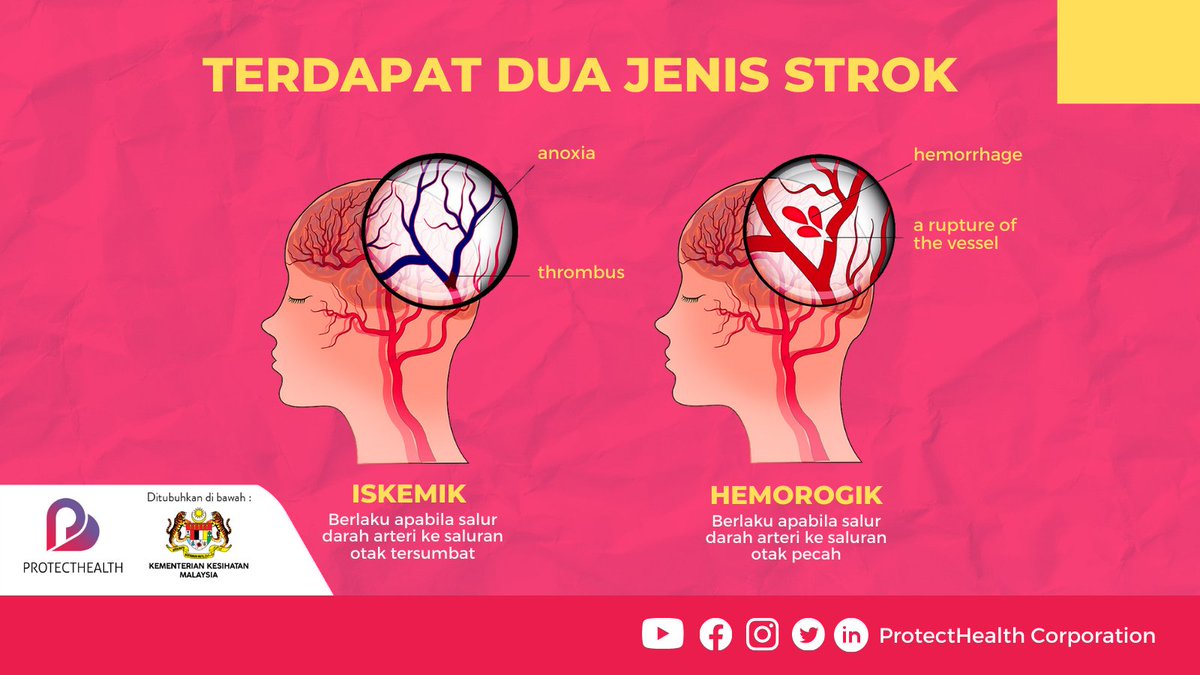 Terdapat Dua Jenis Strok Utama Iaitu Strok Iskemik Dan Strok Hemoragik Strok Iskemik Berlaku Apabila Salur Darah Arteri Ke Bahagian Otak Tersumbat Strok Hemoragik Pula Berlaku Apabila Salur Darah Arteri Ke Bahagian
