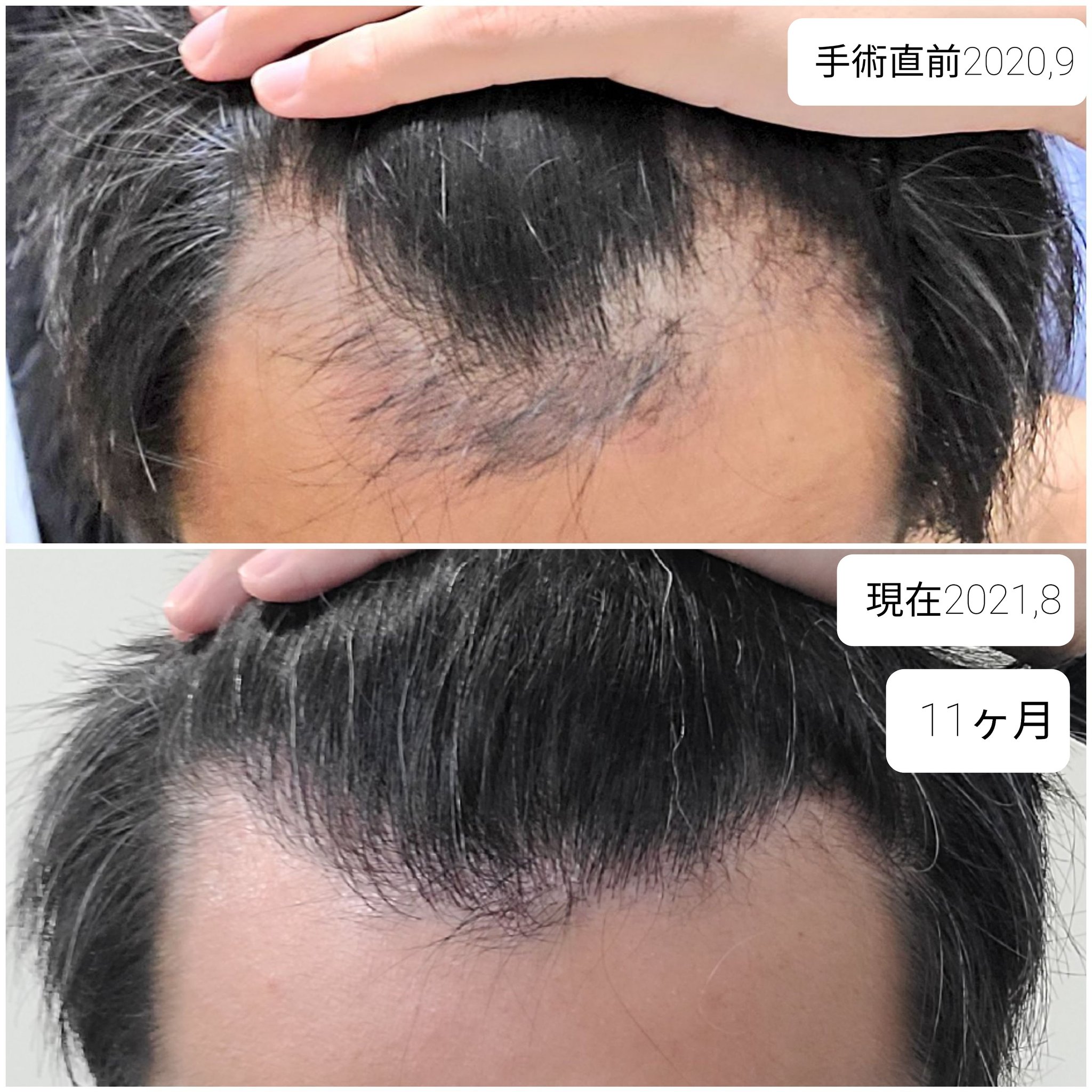 植毛 Fut 1511株 男 36歳 O7sgdnq05qa5qqb Twitter