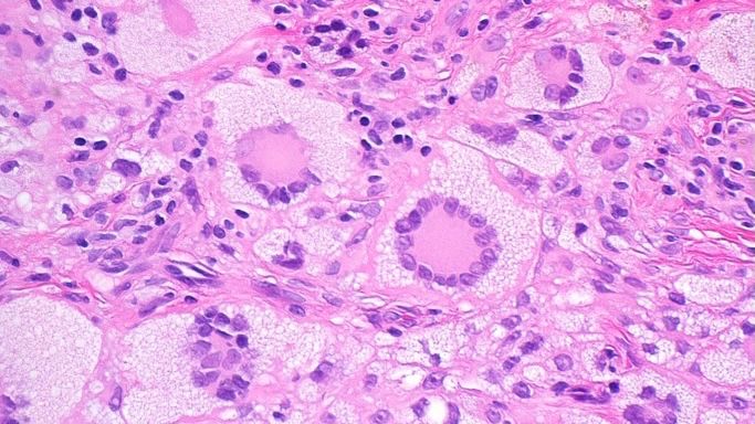 Yellow-red papule. Forehead of 5yo boy. One pic only. Your diagnosis? Answer &amp; 5 minute video here ➡️ kikoxp.com/posts/6846. #pathology #pathologists #pathTwitter #dermpath #dermatology #dermatologia #dermtwitter