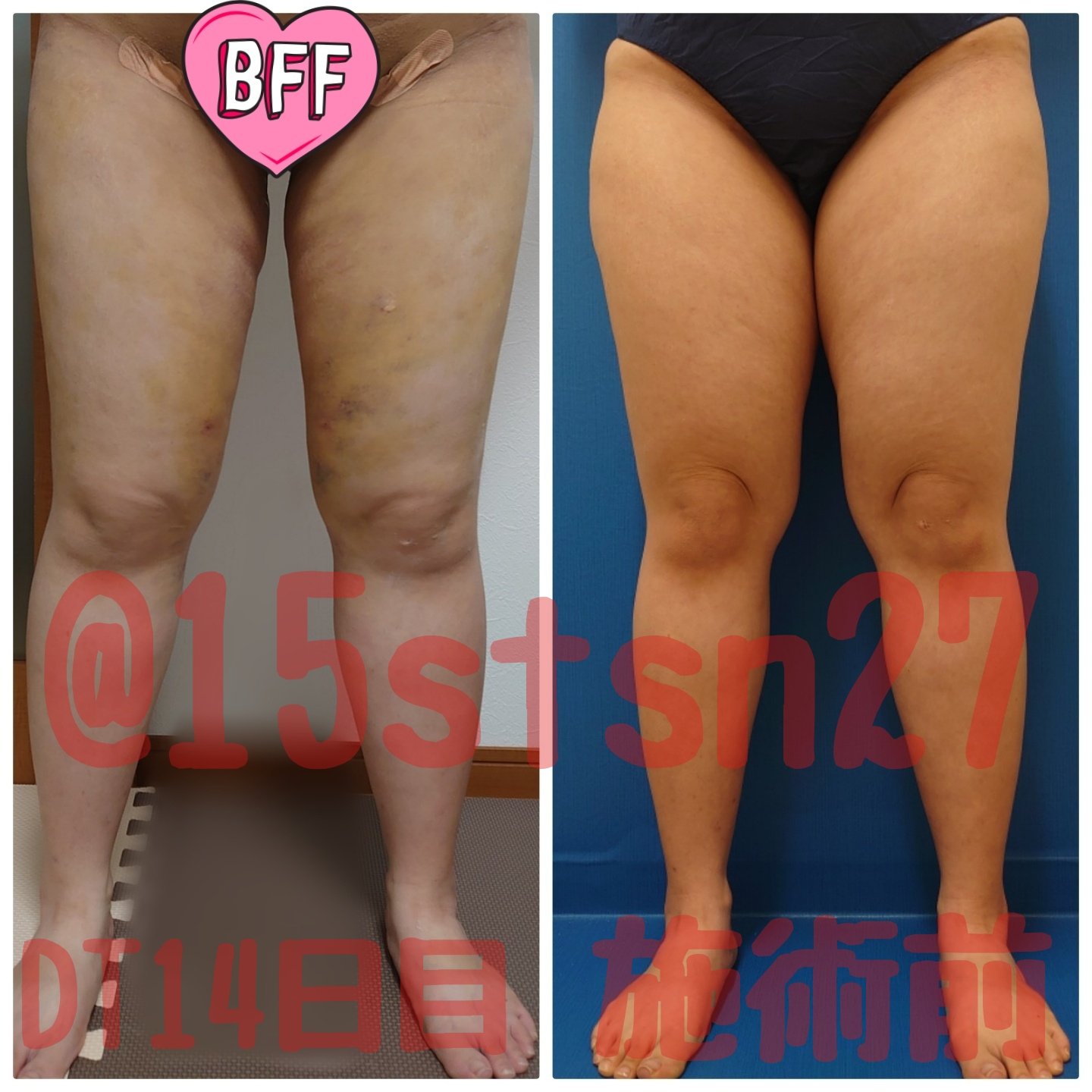 ごんちゃん 太腿臀部脂肪吸引dt中 15stsn27 Twitter