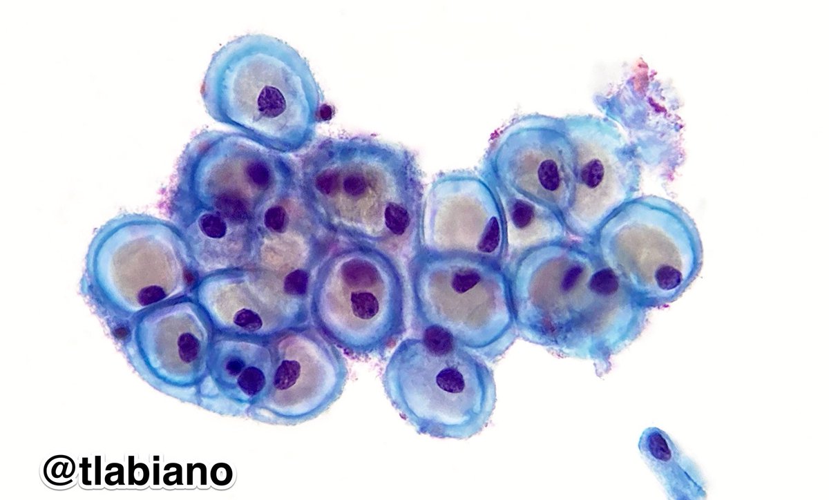 Glycogenated intermediate cells on #papsmear or “Navicular cells” 🛶

🍯💙They contain golden yellow glycogen in the cytoplasm 

🤰👩🏽‍🦳They are abundant in the post-ovulatory phase,during pregnancy and in some menopausal smears #cytopath #cytology #beautyandbenign  #simple #worth