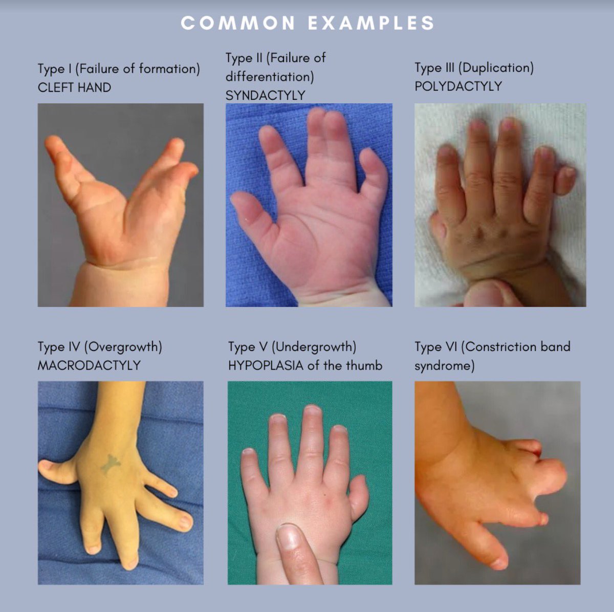prscommunity's tweet photo. Presenting our next educational post on congenital hand anomalies !! https://t.co/MNdJ9hbTbg