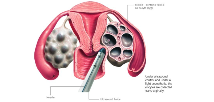 ¿Cómo es la punción ovárica? blgs.co/0NTVRy
