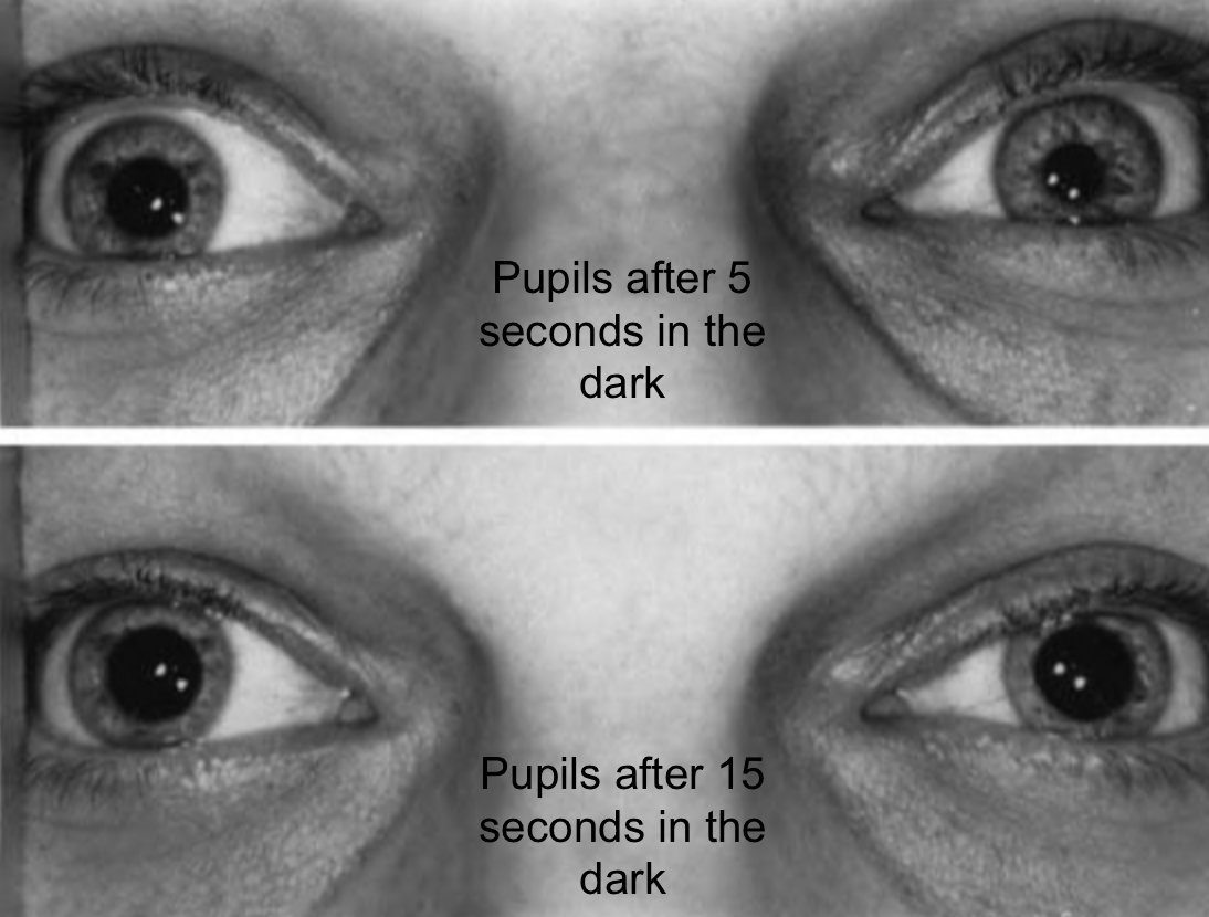 NOVEL Visual Diagnosis Challenge: Can you name this exam finding and the associated syndrome (don’t forget laterality!)? Click the link below for the answer and more information. #nanostweets #meded  #localeyes 

collections.lib.utah.edu/search?q=subje…