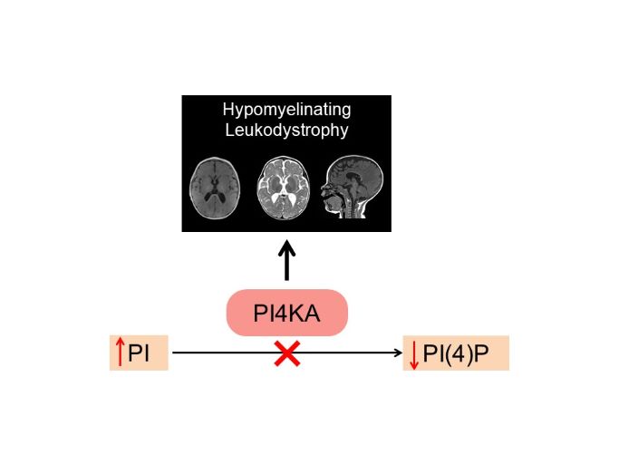 Verdura et al. report a novel rare brain metabolic disorder caused by recessive mutations in PI4KA, which encodes an enzyme with a pivotal role in phosphoinositide metabolism at the cell membrane.  @PujolLab
bit.ly/3D1Xjpn