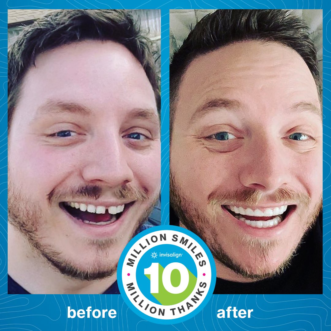 Invisalign's tweet image. Nothing puts a smile on our face like seeing a great Invisalign treatment transformation. 😊

📸favorxiv

#invisalign #invisalignsmile