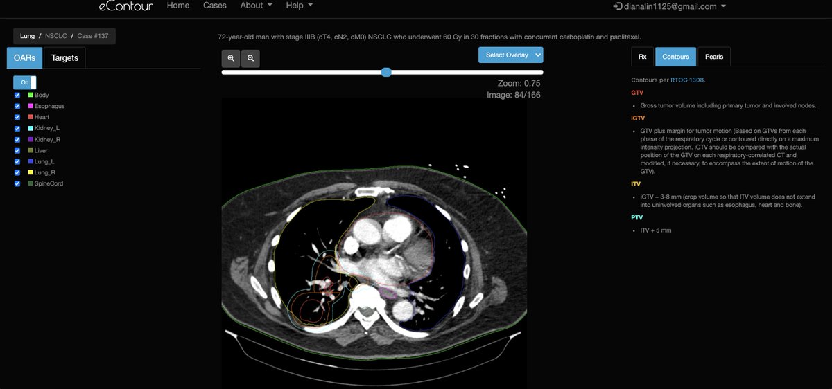 eContourRadOnc's tweet image. 🚨🚨🚨 We&apos;ve got a new #radonc case from @uofcincy LIVE  on #econtour 💻! View 👓 this interesting case on locally advanced NSCLC NOW at econtour.org/cases/137!