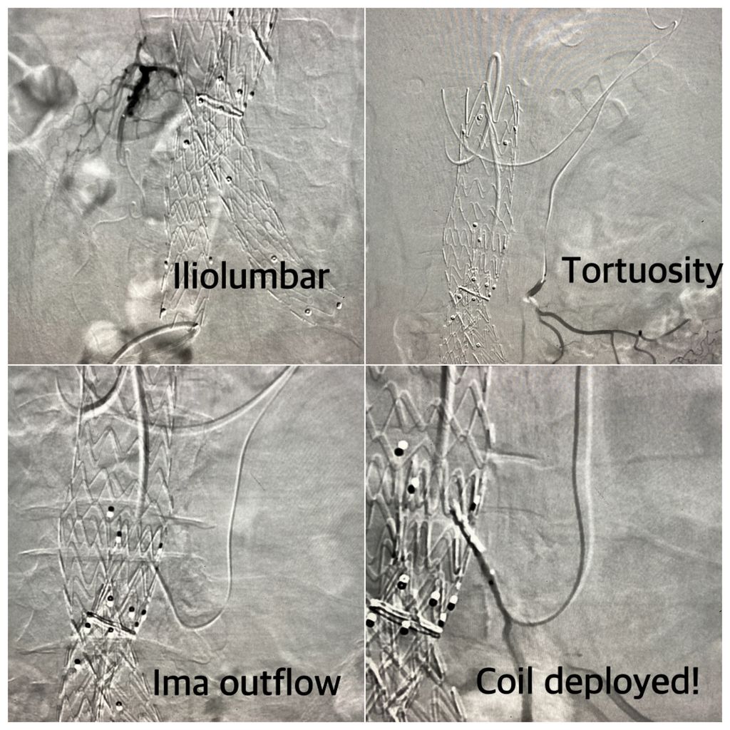 Type II endoleak w hx of AAA rupture.  Embolized iliolumbar inflow then went for the IMA outflow. Coil jammed in my microcatheter due to marginal artery tortuosity. Stepped out to review images, my tech flushed the micro...and sent the coil into perfect position 😀 #iRad #lucky