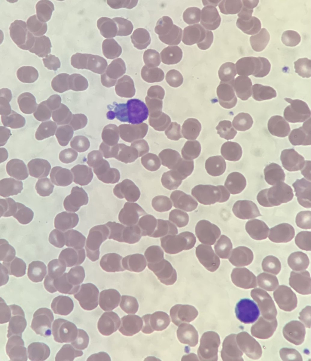 MarrowandBlood's tweet photo. Quite bizarre nuclear morphology. Again something that you don’t see every day!! #bloodfilm #morphology https://t.co/gtANY9TzwL