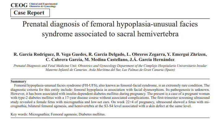 CEOGjournal's tweet photo. #CEOG #Micrognathia #Femoral #Agenesis #Prenatal #Diagnosis
Prenatal diagnosis of femoral hypoplasia-unusual facies syndrome associated to sacral hemivertebra
@jacques_balayla @PregnancyAll
For more details: https://t.co/FhsFy3evY1 https://t.co/M4oJzgUlQz