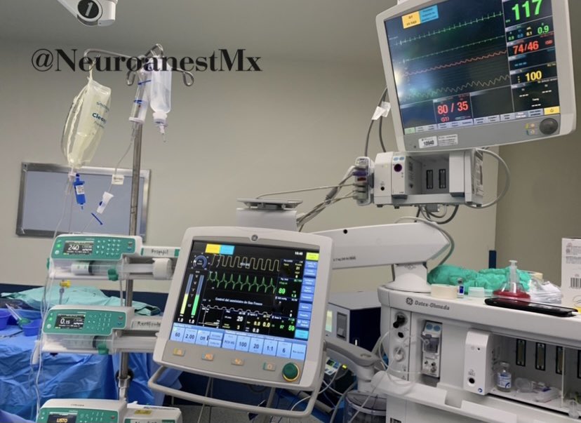 NeuroanestMx's tweet photo. Endoscopic suturectomy for sagittal and lambdoid #craniosynostosis + #IONM 
Female 5 months, G:1 36 GW. Without other important antecedent. Weight 8 kg. Normal laboratories.
#anestheticmanagement TIVA: Propo-remi-lido + invasive monitoring. CVC 4 fr Right jugular US guidance. https://t.co/rse7LiGJqn