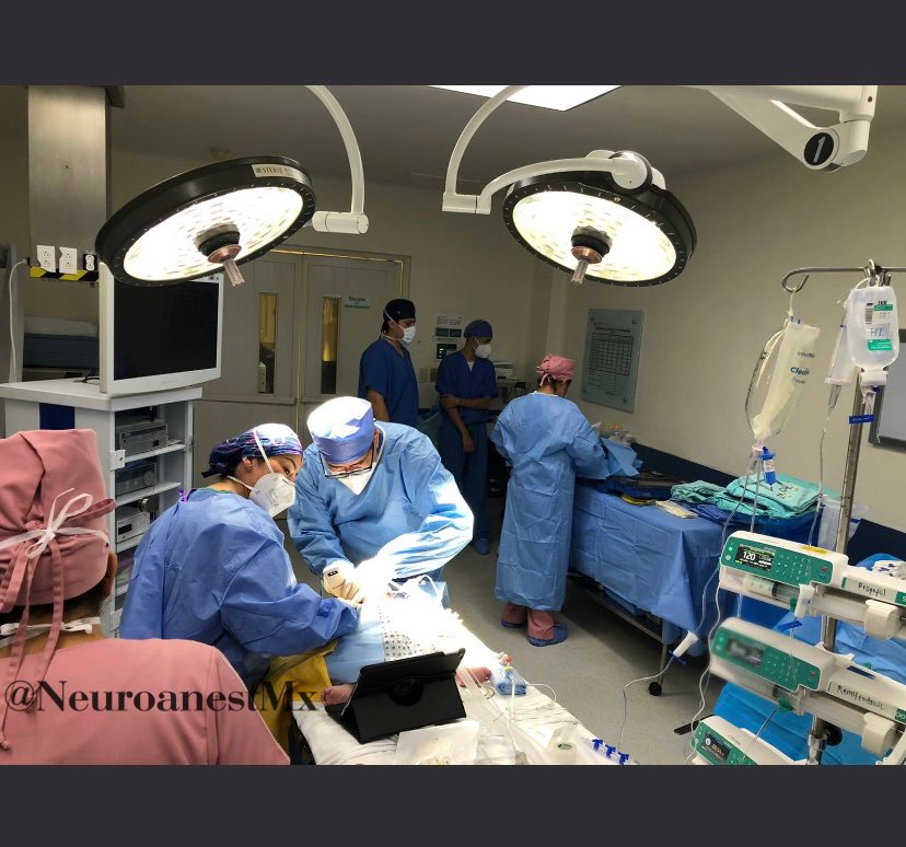 NeuroanestMx's tweet photo. Endoscopic suturectomy for sagittal and lambdoid #craniosynostosis + #IONM 
Female 5 months, G:1 36 GW. Without other important antecedent. Weight 8 kg. Normal laboratories.
#anestheticmanagement TIVA: Propo-remi-lido + invasive monitoring. CVC 4 fr Right jugular US guidance. https://t.co/rse7LiGJqn