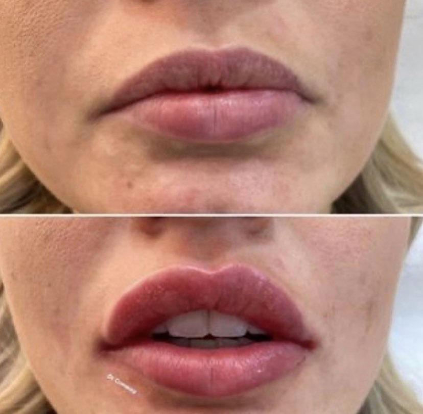 Our aesthetics clinic is back on September 1st!!! 🎉5pm-7pm 😁Last few slots available!!!
<a href="/doctor/">Doctor.com, a Press Ganey Solution</a>.conway is an advanced aesthetics practitioner specialising in botox, dermal filler &amp; rhinoplasty techniques✨✨

Email us to book in info@chilloutspa.co.uk