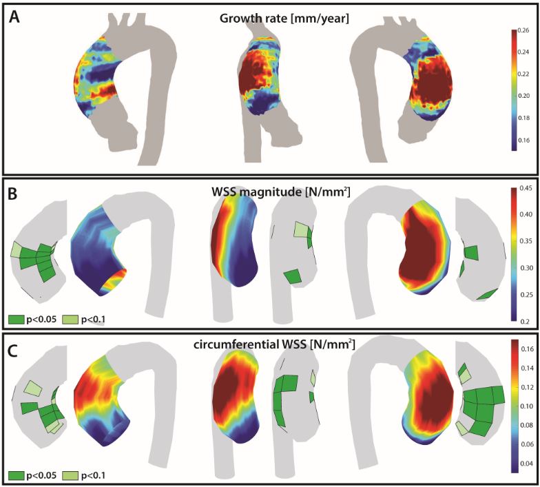 andreaguala6's tweet image. In this #ESCAbstract on the #ESCCongress cyim.page.link/37gr via @escardio we show that wall shear stress by #whyCMR predicts co-localised progressive aortic dilation rate in #bicuspid aortic valve patients, a clear widows into pathophysiology. This was possible...