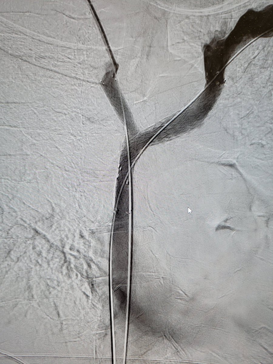 Patient with malignant SVC stenosis and left  thrombosis. Overnight TPA lysis followed by thrombectomy with the Lightning CAT 12 system and kissing SVC stents. Beautiful results! Great work by Dr. Nameet Patel and <a href="/DrSarahAbdulla/">Sarah Abdulla, MD</a>. <a href="/TempleRadRes/">Temple Radiology Residents</a> <a href="/PenVascular/">Penumbra Vascular</a> <a href="/SIR_ECS/">SIR ECS</a> <a href="/SIRRFS/">SIR RFS</a> #IRAD
