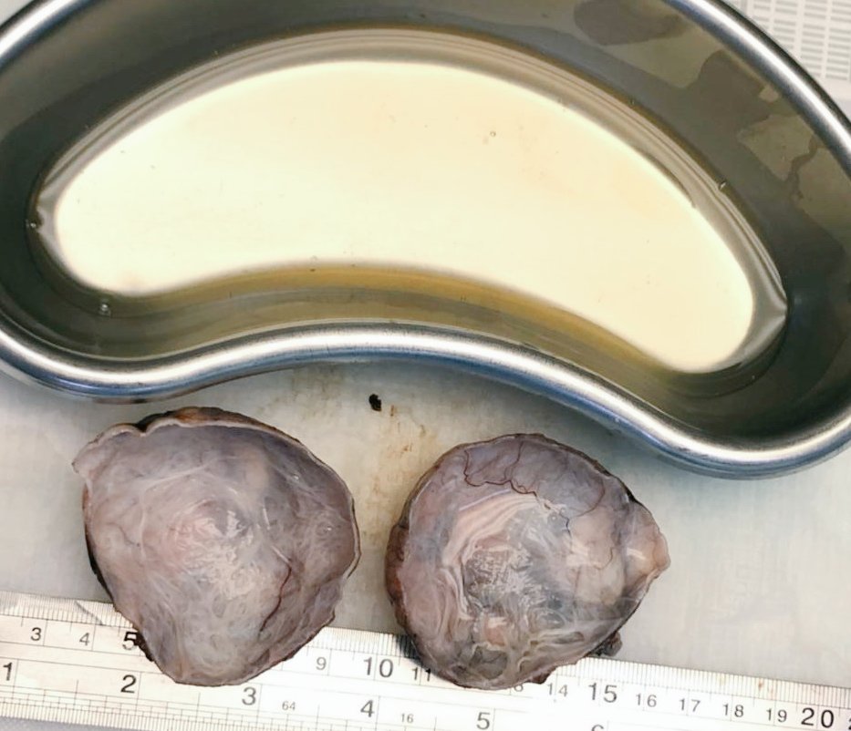 Komalgang's tweet photo. Pelvic cyst...close to broad ligament!#FGTpath #FIGO @Dramanyhassany1 @Gowri_passionP @kriyer68 @VijayPatho https://t.co/Xfn5FSJWtu