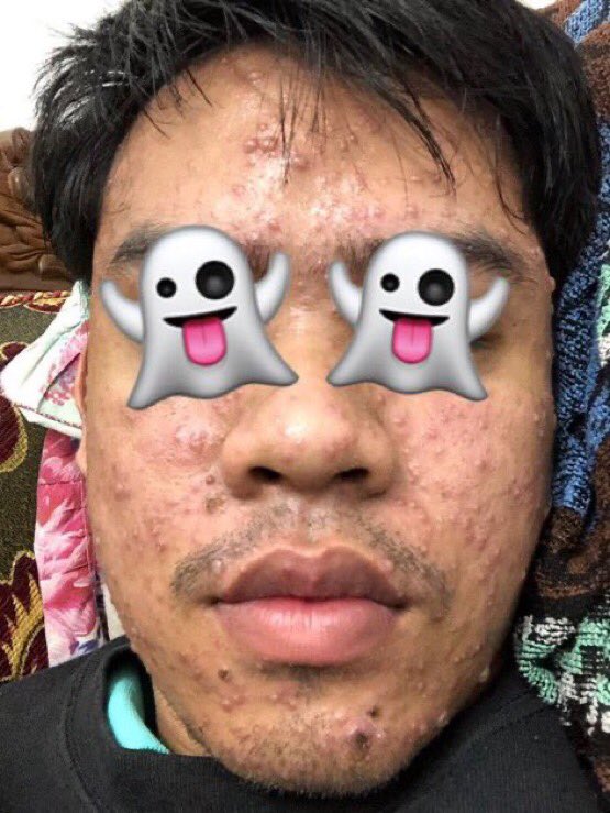 qiyyla's tweet photo. When they said good thing takes time. This is what it means 😍

You may not see the results overnight. But remember, consistency is the key.

Full skincare routine - Thread 👇🏻 https://t.co/Pl4wa48ldd