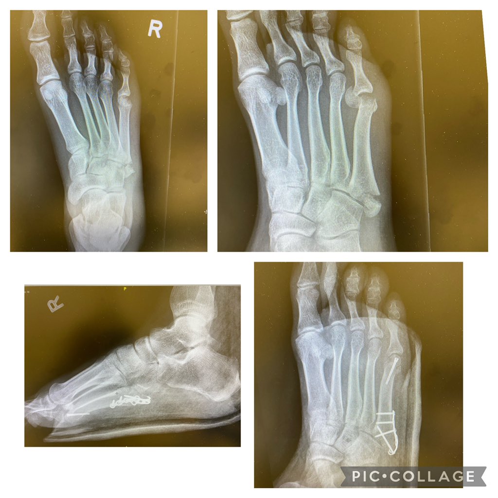 derekhpark's tweet photo. (Posted w permission) 
This young man had an unusual injury while riding and fractured both head and base of the 5th metatarsal of his foot. 

At first glance the head fragment didn’t look bad - but a closer look shows that it was completely displaced. https://t.co/XACRlQ5SFC