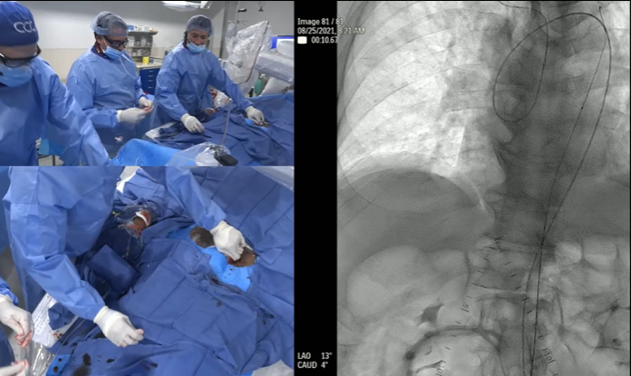 ccclivecases's tweet photo. Watch LIVE now! with @PK_MountSinai
"Calcified Ostial Common Iliac Artery Intervention"
https://t.co/lLZG6WvdPN
#peripheral #endovascular #cardiology #interventionalcardiology #cardiotwitter #mountsinai #livecases #ccclivecases https://t.co/EpFy6SHz24
