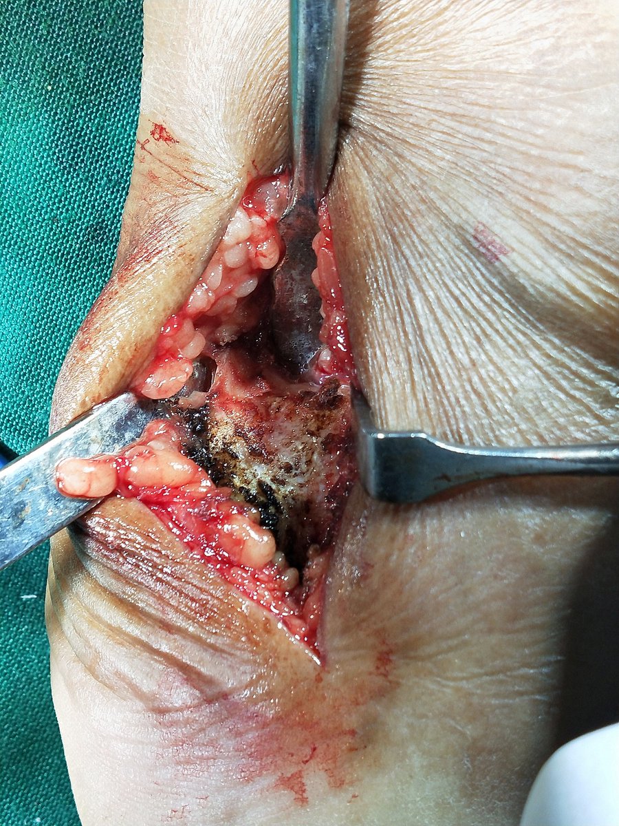 anconeus tweet media