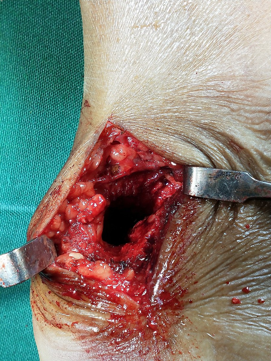 anconeus tweet media