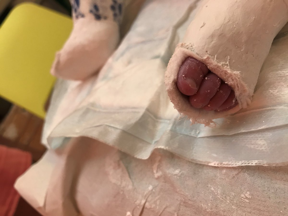 STEPS_Charity's tweet photo. We are very pleased to share the news that the British Society of Children's Orthopaedic Surgery (BSCOS) Consensus Group for Clubfoot has achieved consensus.  

Click on https://t.co/HO7IciCVmI to learn more about the guidelines.

@BSCOS_UK https://t.co/o0g2PEfYAa