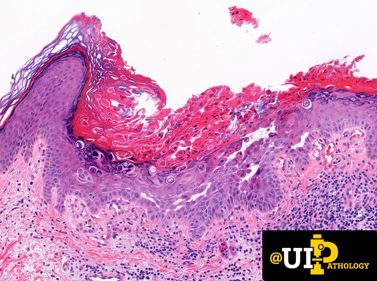 UIPathology's tweet photo. Shave biopsy of a solitary pink plaque on the thigh of an adult. 
❓What is your diagnosis? 
❓How may the clinical presentation change your diagnosis? 

📸:@tracyshalvorson 

#IowaPath #dermpath #PathTwitter https://t.co/Tw2Fi7Fygm