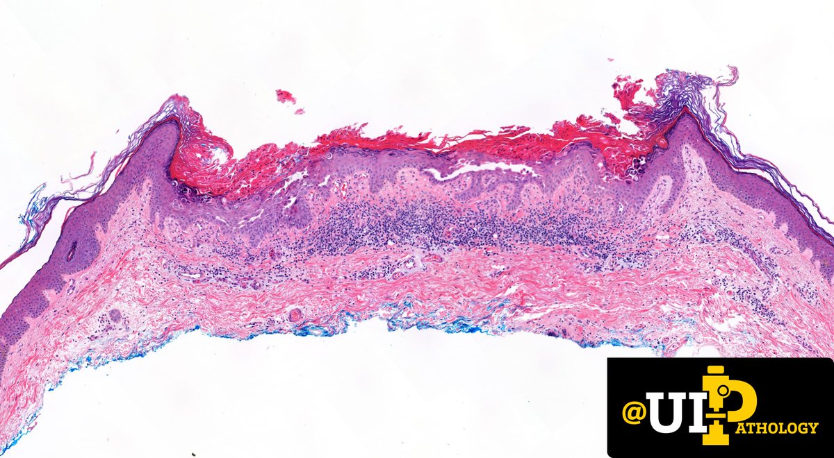 UIPathology's tweet photo. Shave biopsy of a solitary pink plaque on the thigh of an adult. 
❓What is your diagnosis? 
❓How may the clinical presentation change your diagnosis? 

📸:@tracyshalvorson 

#IowaPath #dermpath #PathTwitter https://t.co/Tw2Fi7Fygm
