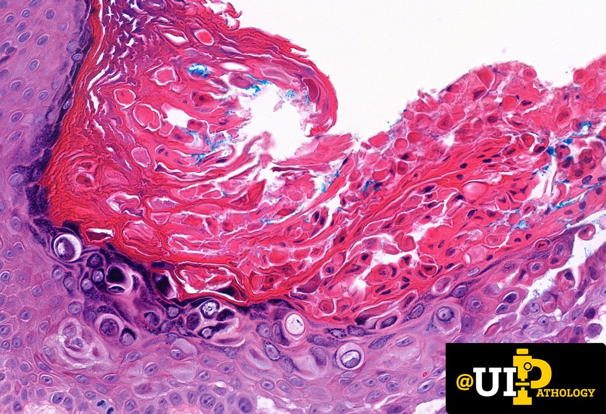 UIPathology's tweet photo. Shave biopsy of a solitary pink plaque on the thigh of an adult. 
❓What is your diagnosis? 
❓How may the clinical presentation change your diagnosis? 

📸:@tracyshalvorson 

#IowaPath #dermpath #PathTwitter https://t.co/Tw2Fi7Fygm
