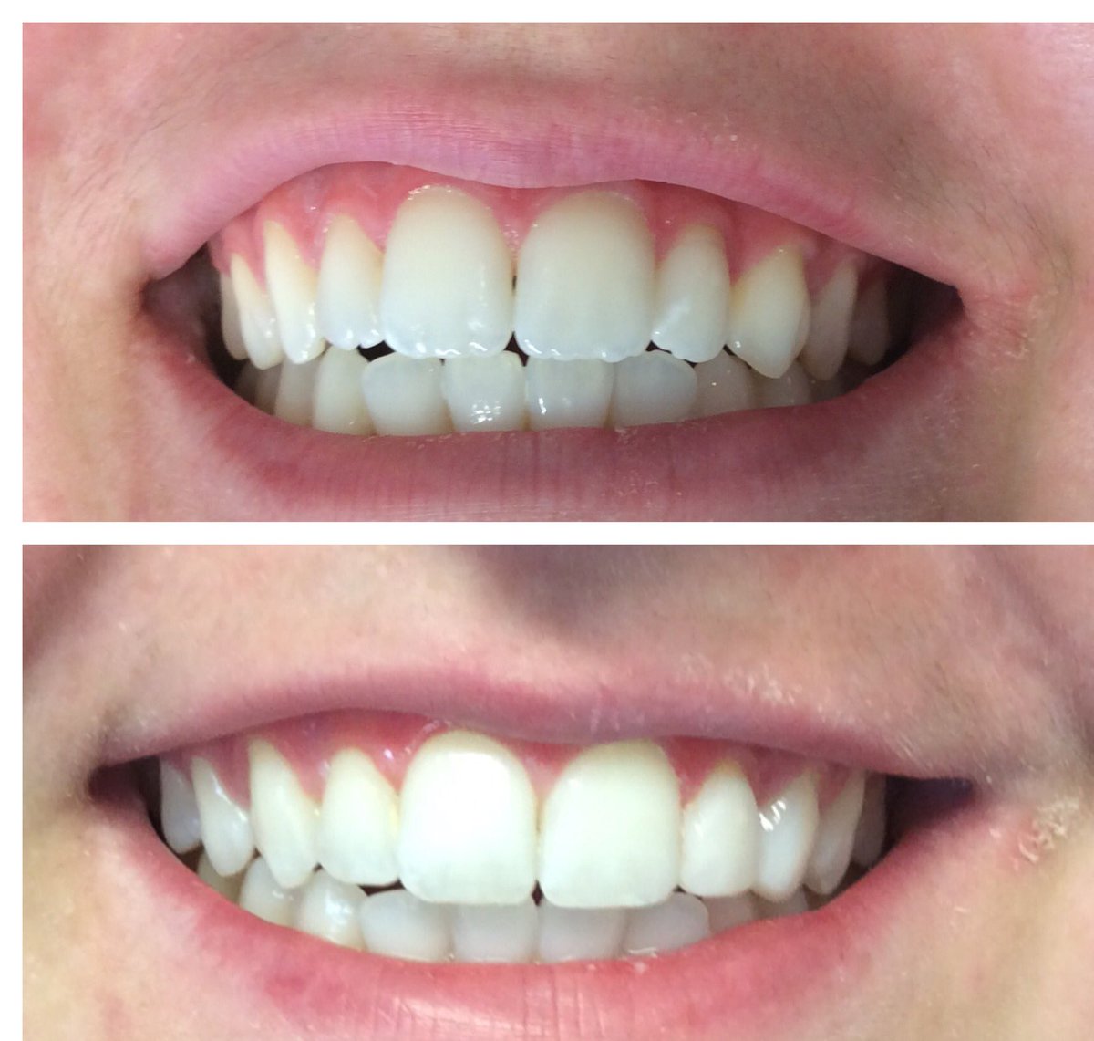 We just love a bit of composite bonding 🙌🏻 Little touches added to make the suttle changes to our fabulous patients smile 😁🦷✨. Call or book online today for a complementary composite bonding consultation 📞