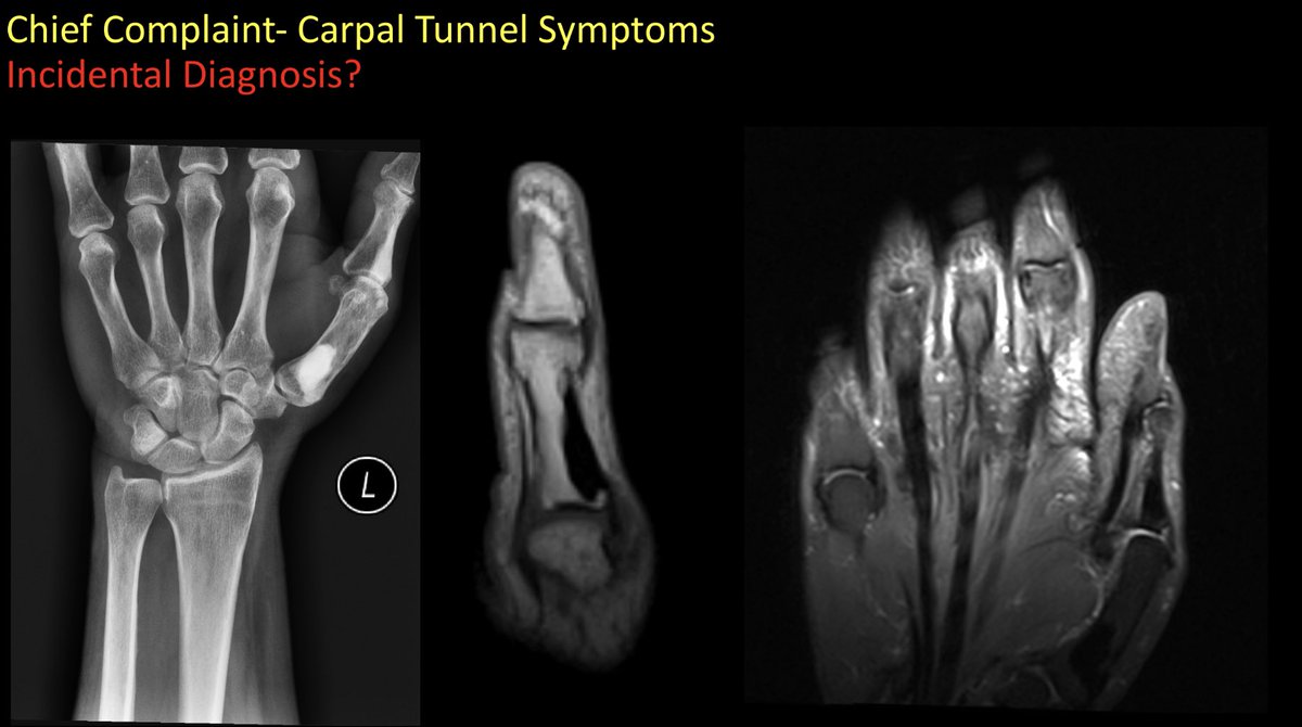 Austin Fischer, DO (@amfischer89) on Twitter photo Case 30- Incidental diagnosis? <a href="/ufjaxrads/">UF Jax Radiology Residency</a> #FOAMed #FOAMrad #radiology #MSKRad #radres #futureradres #MedEd #medtwitter #orthotwitter <a href="/SSRbone/">Society of Skeletal Radiology</a> <a href="/ssr_rwg/">SSR_RWG</a> @KurraChandana Case 30- Incidental diagnosis? <a href="/ufjaxrads/">UF Jax Radiology Residency</a> #FOAMed #FOAMrad #radiology #MSKRad #radres #futureradres #MedEd #medtwitter #orthotwitter <a href="/SSRbone/">Society of Skeletal Radiology</a> <a href="/ssr_rwg/">SSR_RWG</a> @KurraChandana