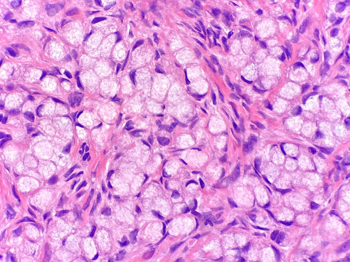 Signet ring cell cancer of Ampulla of Vater—first ever case reported in a  teenager and a review of literature - Asad Ali Kerawala, Abid Jamal, Lubna  Saleem, 2021