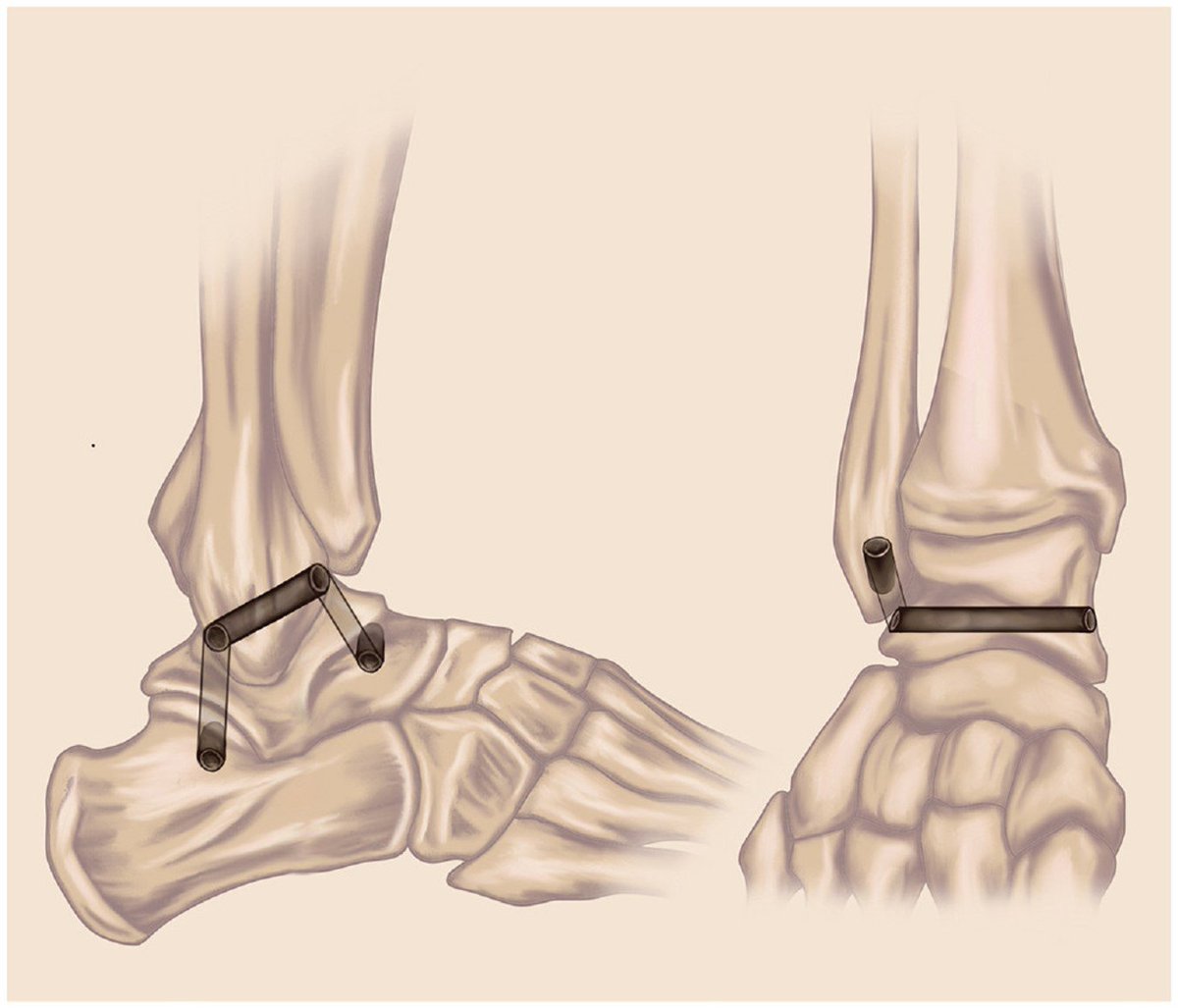 aossmjournals's tweet image. Autograft hamstring reconstruction technique for severe and recurrent #ankle instability improves radiographic and clinical outcomes  #ankleinstability
ow.ly/VHLl50FWpk5