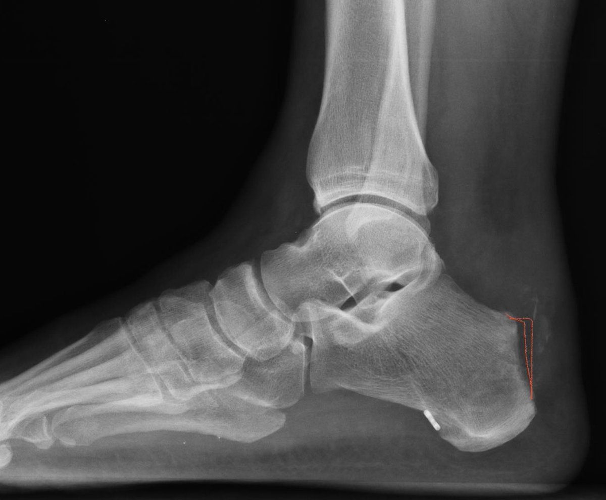 FootAndAnkleMD tweet media