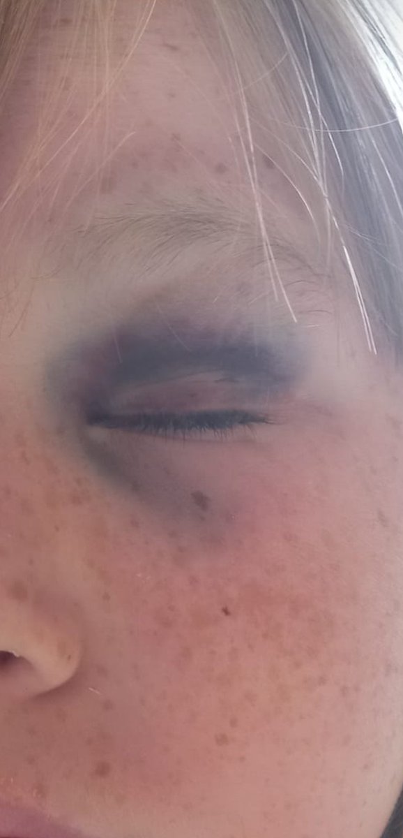 My poor baby 
Headbutted in a rugby tackle
#hardasnails
<a href="/MadPadMcGuirk/">Paddy McGuirk 🏆</a>