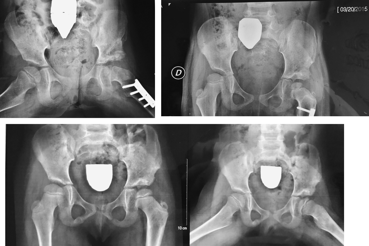 DocVictorVargas's tweet photo. 4a6m Luxación cadera en desarrollo. Reducción abierta, resección femoral y osteotomía pélvica Pemberton, 6 años POP.
4y6m Neglected Developmental Hip Dislocation. Open reduction, femoral resection and Pemberton Osteotomy. Follow-up 6 years POP.
#displasiadecadera #HipDysplasia https://t.co/w5giDgBFmX