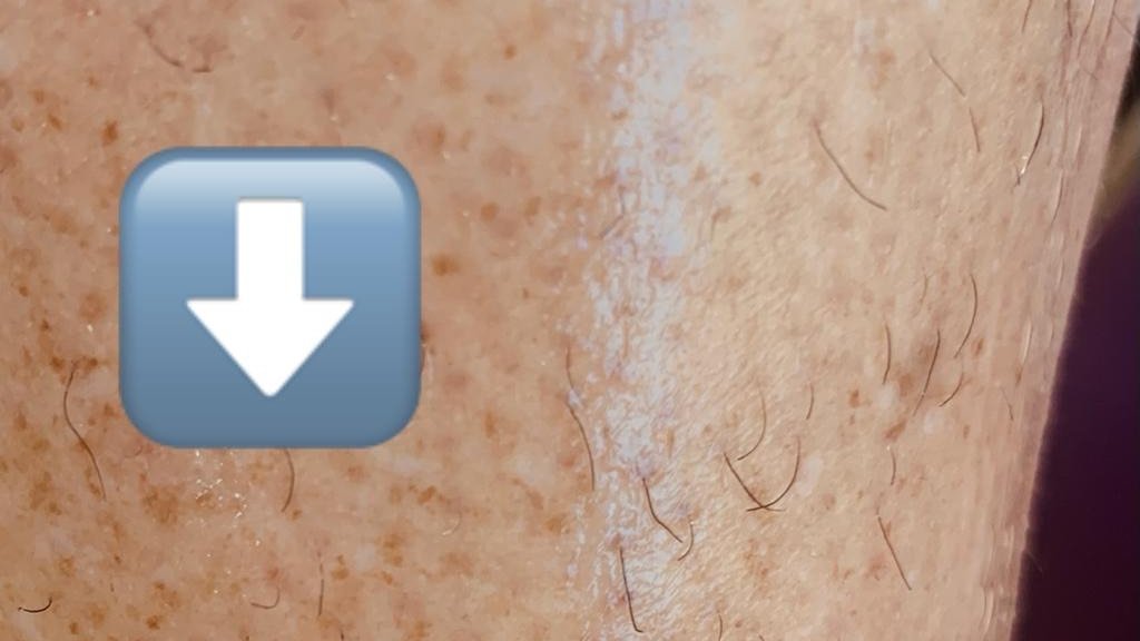 The Podiatrist (@thepodiatristuk) on Twitter photo ...It’s not just how often, it’s also the application 🎯 Apply moisturiser in one direction, so hair is laying flat, to prevent folliculitis & keep that protective barrier intact!
<a href="/nzfran88_fran/">Fran Campbell | Podiatrist</a> #10daysoftissueviability #moisturise #application #Day3 #preventingfolliculitis ...It’s not just how often, it’s also the application 🎯 Apply moisturiser in one direction, so hair is laying flat, to prevent folliculitis & keep that protective barrier intact!
<a href="/nzfran88_fran/">Fran Campbell | Podiatrist</a> #10daysoftissueviability #moisturise #application #Day3 #preventingfolliculitis