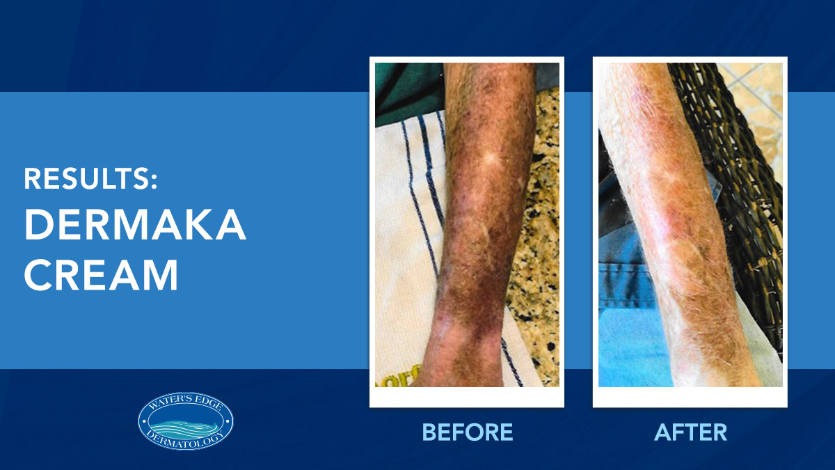Check out these amazing before-and-after photos from one of our patients. The transformation was courtesy of Dermaka Cream, an all-natural plant-based cream that can be used to treat all types of skin issues and speed healing. To order &gt; hubs.la/H0W1rhv0