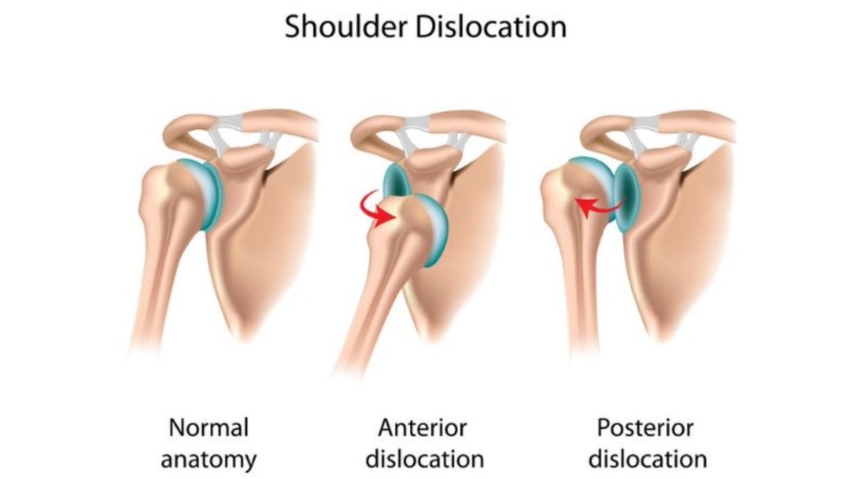 Flazzaraville's tweet photo. Did you know that a #dislocatedshoulder can also provoke systemic symptoms such as nausea, lightheadedness, vomiting and sweating. Patients should not attempt to return the shoulder to its normal position (aka reduction) because... https://t.co/OBwxScKR4a  #shoulderinstability https://t.co/3uuvMPH6O6