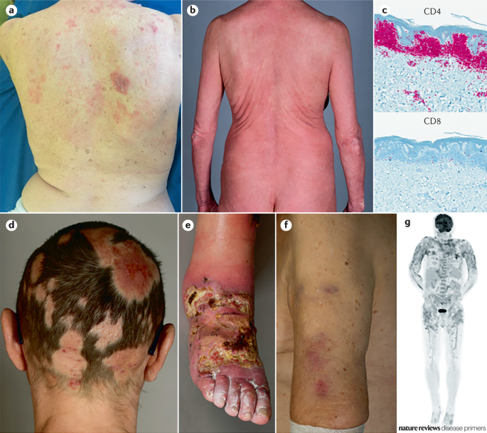 Clinical and pathological presentation of selected cutaneous T cell lymphoma subtypes.