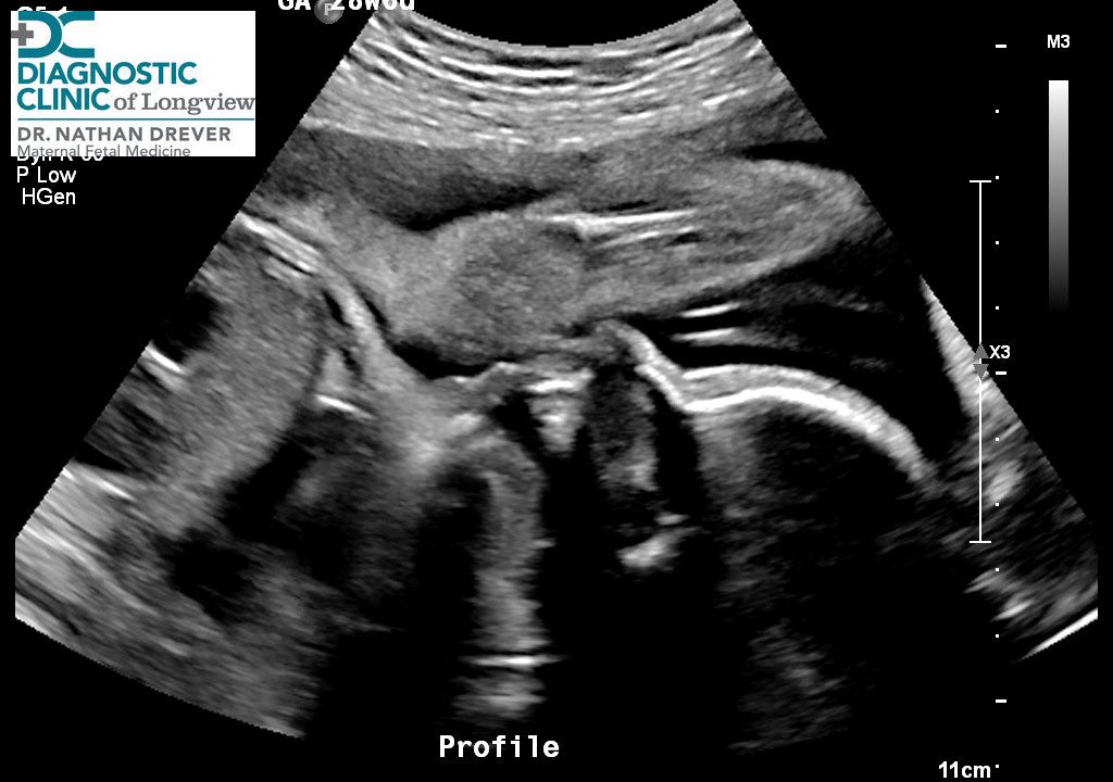 haleybrooke21's tweet photo. That’s my baby’s head, with her KNEE touching her chin. 
I’ve got the Gymnastic Olympian of babies growing inside of me, no big deal. https://t.co/mUNLmmZlMG