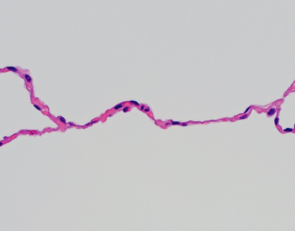 (H&E, 600x) Lung, interalveolar septum #histology #anatomy #pathology #oncology #cancer #lung #emphysema #medschool #mayoclinic #usmle