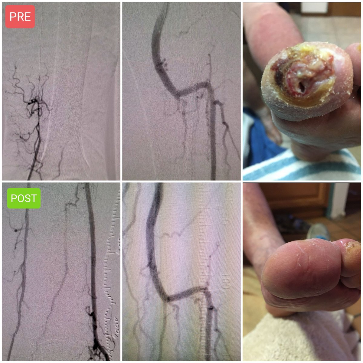 Patient told amputation is necessary. This #irad thinks not!!! #PADawareness #limbsalvage #CLIfighters