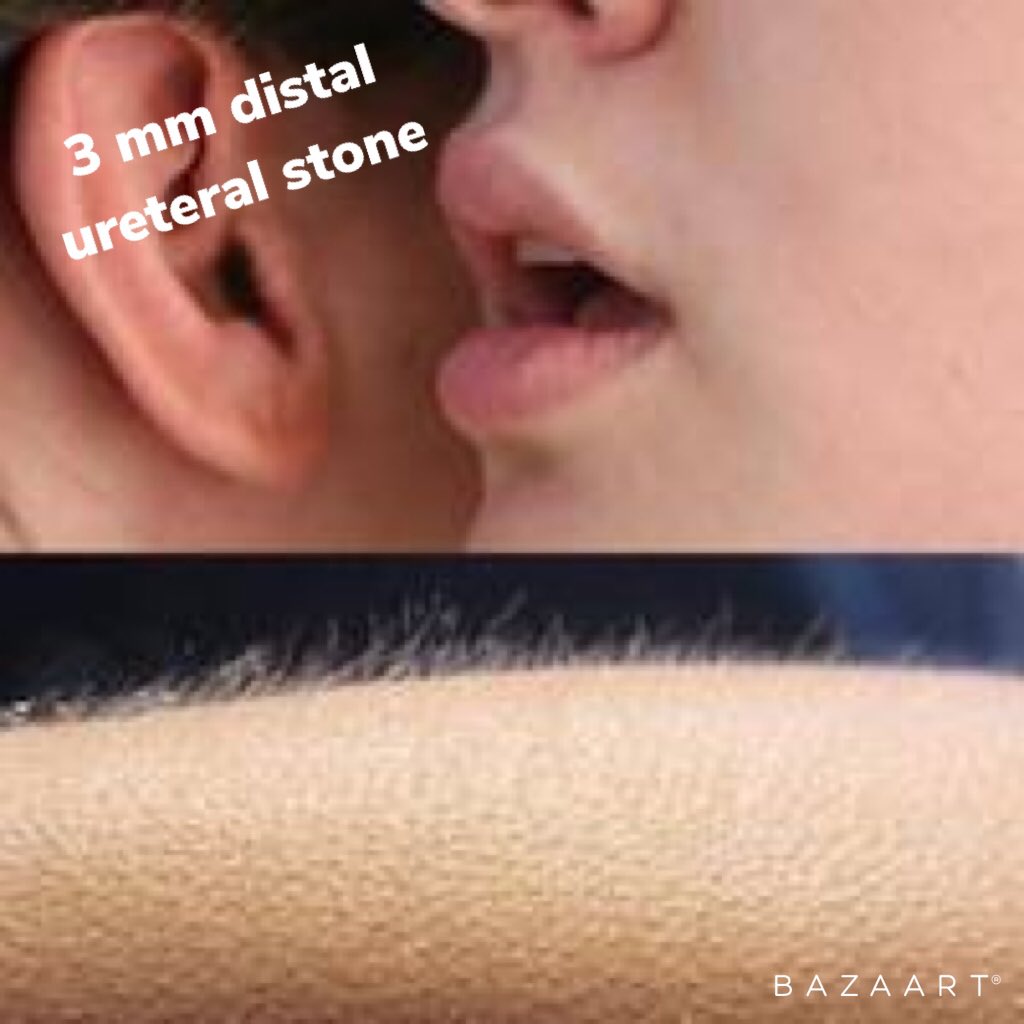 OsinskiReflex's tweet image. ✅ semirigid scope
✅ basket
✅ 5 minute case
✅ patient super satisfied 

#UroSoMe #urology