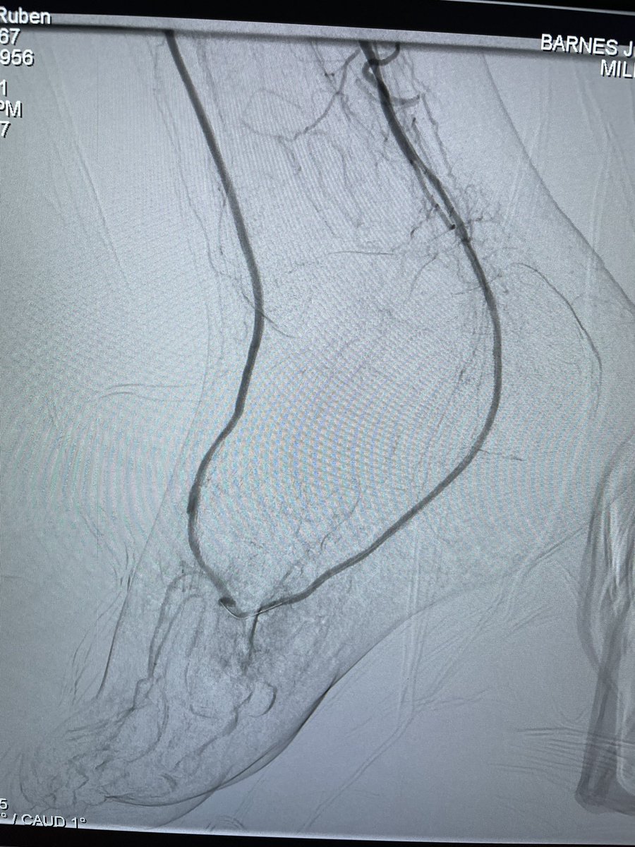 Carlos Guevara MD, FSIR (@carlosguevarair) on Twitter photo Toe necrosis with TBI 0.1 Foot supplied by small branches from PT. AT, PT loop and plantar revascularization with laser and poba. @Saukalaka <a href="/ZagumBhatti/">Zagum Bhatti MD</a> <a href="/Sushinsk/">Sasha Ushinsky</a> <a href="/AuryonPad/">The Auryon Atherectomy System</a> <a href="/kmadass/">Kumar Madassery</a> <a href="/SDhandMD/">Sabeen Dhand</a> <a href="/roblookstein/">Robert A Lookstein MD, MHCDL</a> <a href="/LessneVIR/">Mark Lessne, MD</a> <a href="/LorenzoPatrone3/">Lorenzo Patrone</a> <a href="/WashUIR/">Mallinckrodt IR</a> <a href="/JVIRmedia/">JVIR</a> <a href="/SIRspecialists/">Society of Interventional Radiology</a> Toe necrosis with TBI 0.1 Foot supplied by small branches from PT. AT, PT loop and plantar revascularization with laser and poba. @Saukalaka <a href="/ZagumBhatti/">Zagum Bhatti MD</a> <a href="/Sushinsk/">Sasha Ushinsky</a> <a href="/AuryonPad/">The Auryon Atherectomy System</a> <a href="/kmadass/">Kumar Madassery</a> <a href="/SDhandMD/">Sabeen Dhand</a> <a href="/roblookstein/">Robert A Lookstein MD, MHCDL</a> <a href="/LessneVIR/">Mark Lessne, MD</a> <a href="/LorenzoPatrone3/">Lorenzo Patrone</a> <a href="/WashUIR/">Mallinckrodt IR</a> <a href="/JVIRmedia/">JVIR</a> <a href="/SIRspecialists/">Society of Interventional Radiology</a>