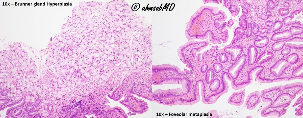 A classic example of peptic duodenitis with:
- Brunner gland hyperplasia
- Foveolar metaplasia

@CreightonGi

#medtwitter #PathTwitter #pathology #Path #path2path