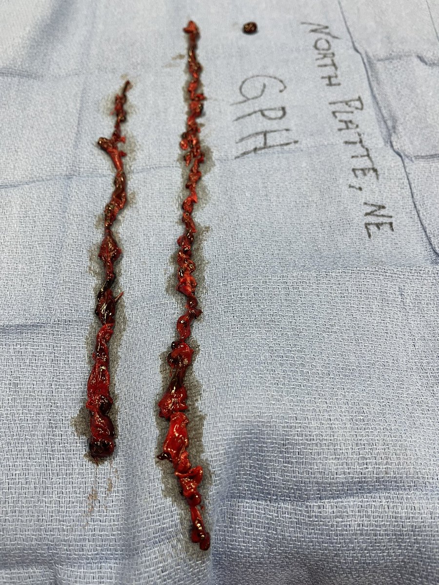70 yo almost massive pe . Cyanotic , syncope with sutures to head. Hr120 sob at rest . High flow oxygen . Er to inari to regular bed no icu , no drips alread oral meds . Home tomorrow. T 24 . <a href="/InariMedical/">Inari Medical</a> <a href="/MichaelJolly77/">Michael Jolly</a> #bloodlessthrombectomy <a href="/jcgeorgemd/">Jon George</a>