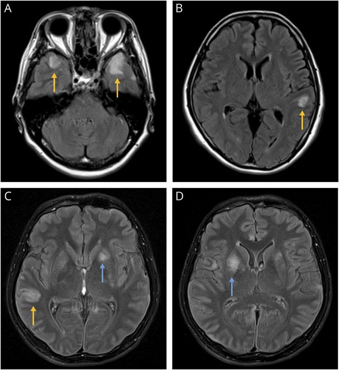 A study by Guasp et al. reports that autoimmune #encephalitis (AE) in patients with #thymoma include several clinical-radiologic syndromes that vary according to the associated antibodies. Learn more: bit.ly/3muZjkk #neuroimmunology #neurology